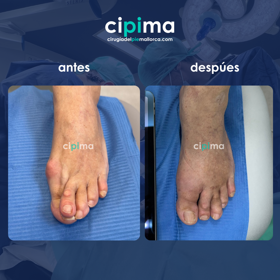 ANTES (1) https://cirugiadelpiemallorca.com/wp-content/uploads/2025/10/ANTES-1-1.png