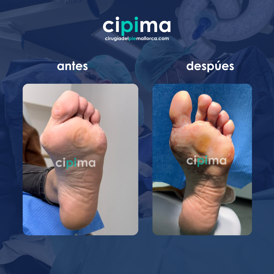 ANTES (1) Antes y despúes cirugia juanete