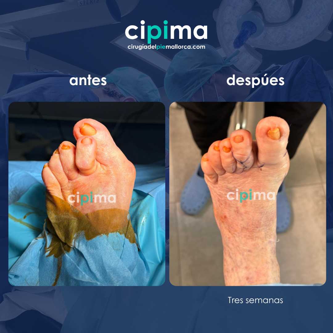 ANTES (1) Juanete operado recuperación 3 semanas