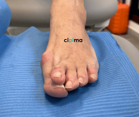 Juanete y segundo dedo cruzado